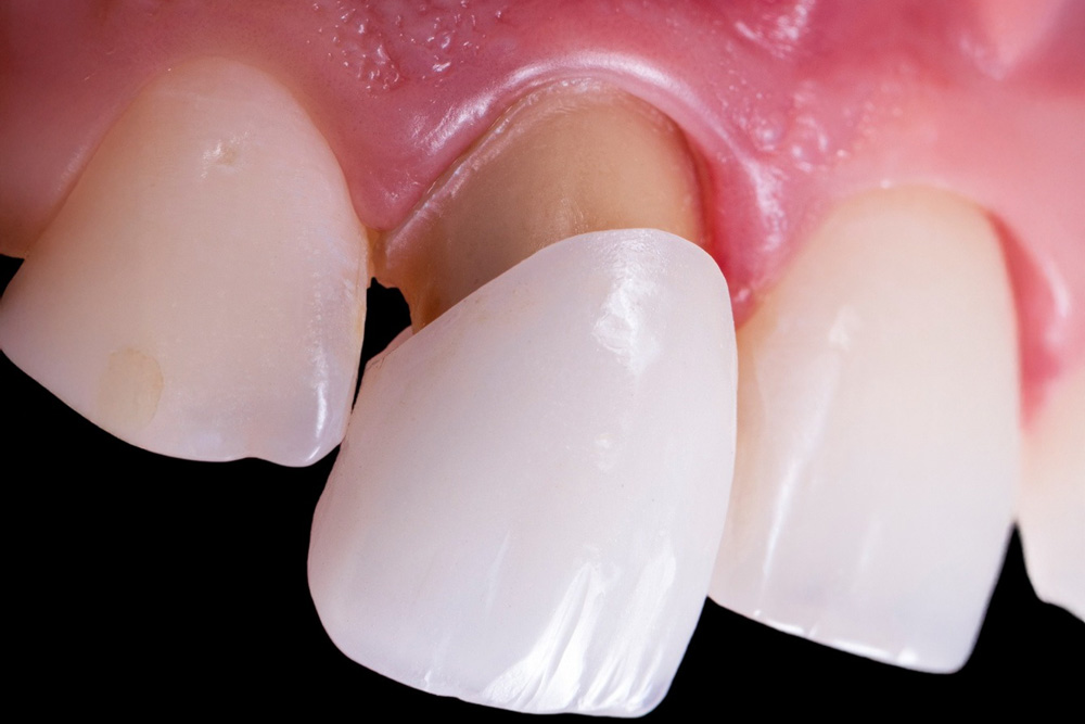 single ceramic crown