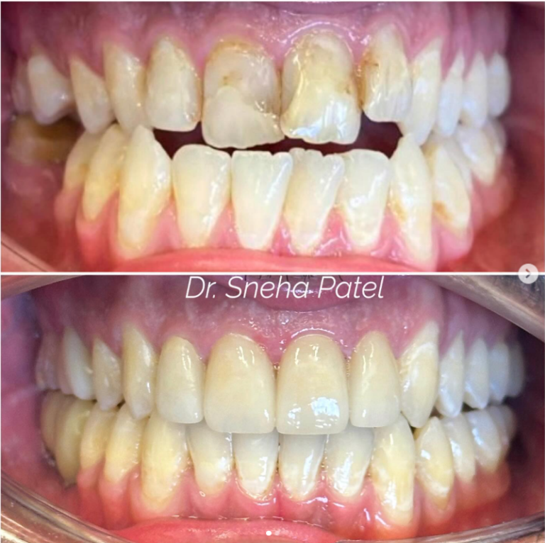 Smile makeover before/after