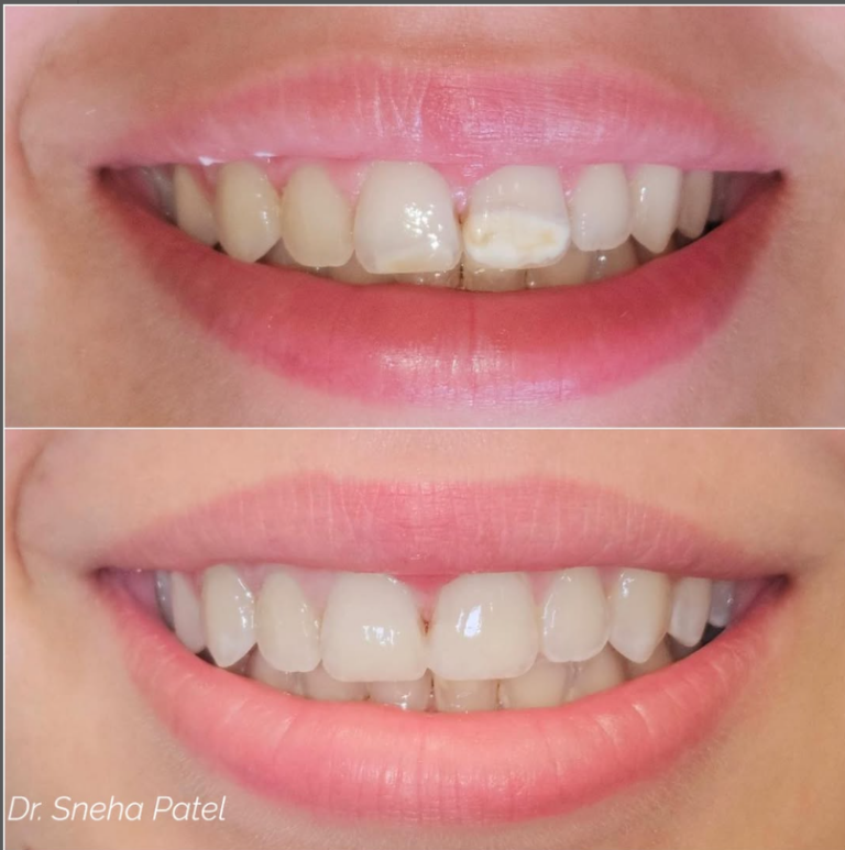 Composite restoration before/after
