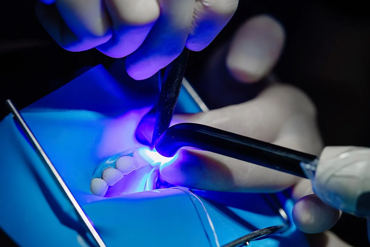 Close-up of dentist hands bonding veneers with UV curing light. Concept of cosmetic dentistry, adhesive dentistry, and professional smile restoration.